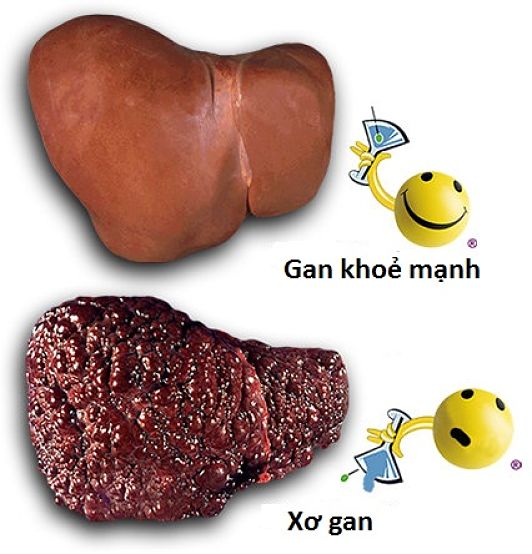 Hấp thu nhiều cồn gây suy giảm chức năng tụy